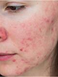 rosacea