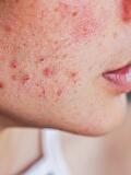 Het overwinnen van hardnekkige Acne