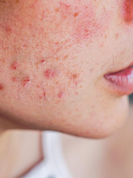 Het overwinnen van hardnekkige Acne